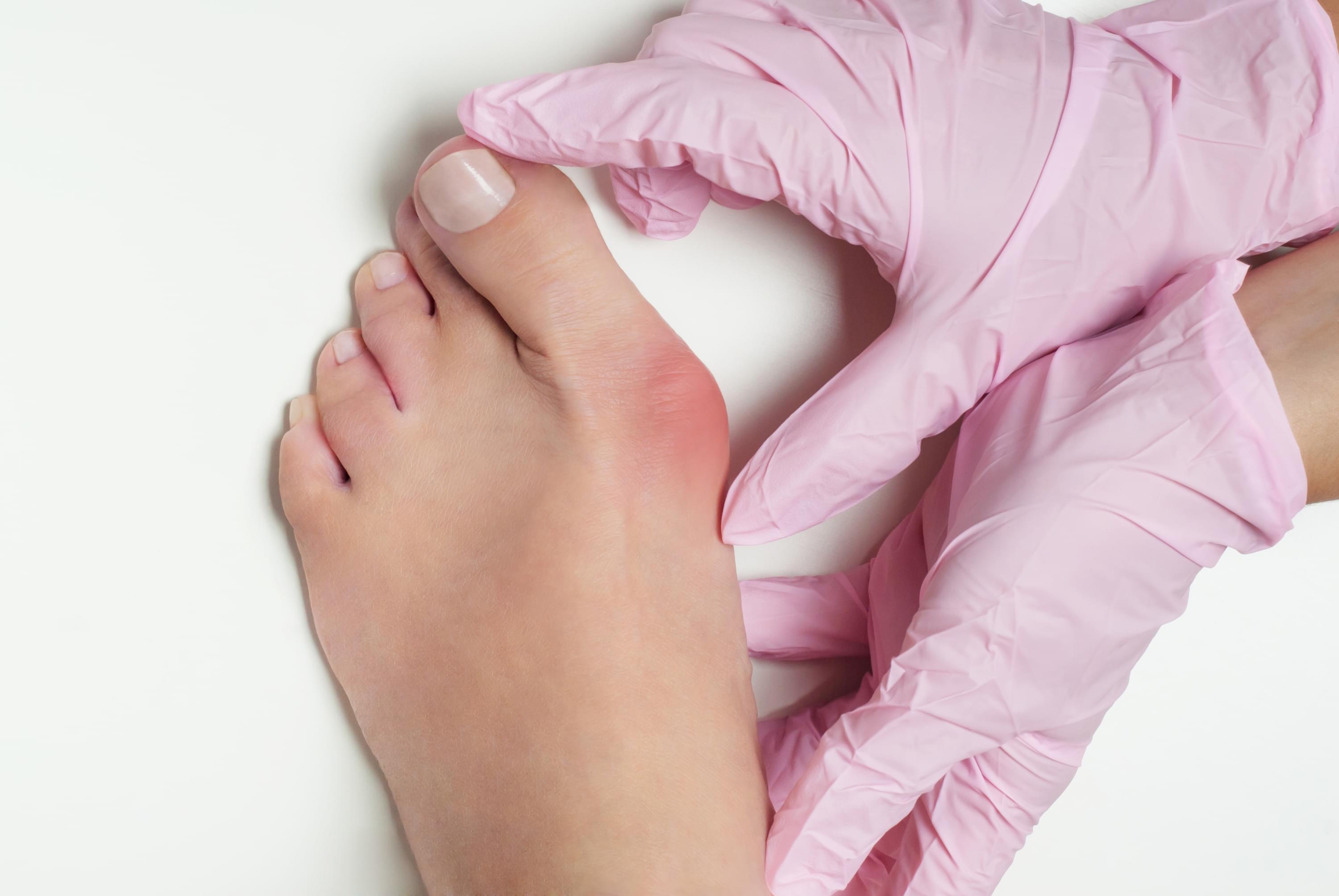 minimally-invasive-bunion-surgery